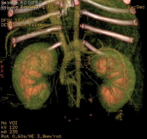CT angiography can also be performed for PSS